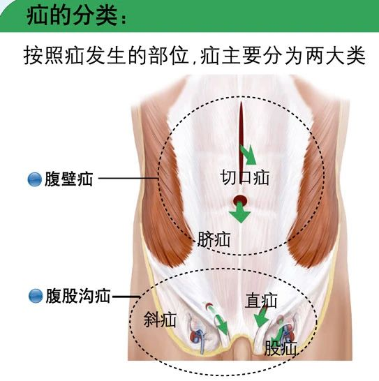 勿以“疝”小而不为——胃肠外科成功完成一例腹壁疝肌后筋膜前修补术(Sublay)
