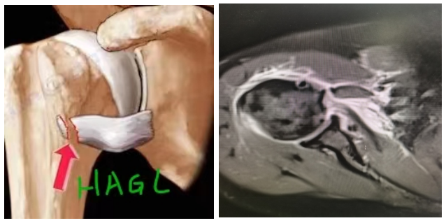 “镜”显神通——关节与运动医学科成功开展一例关节镜下HAGL损伤修补术